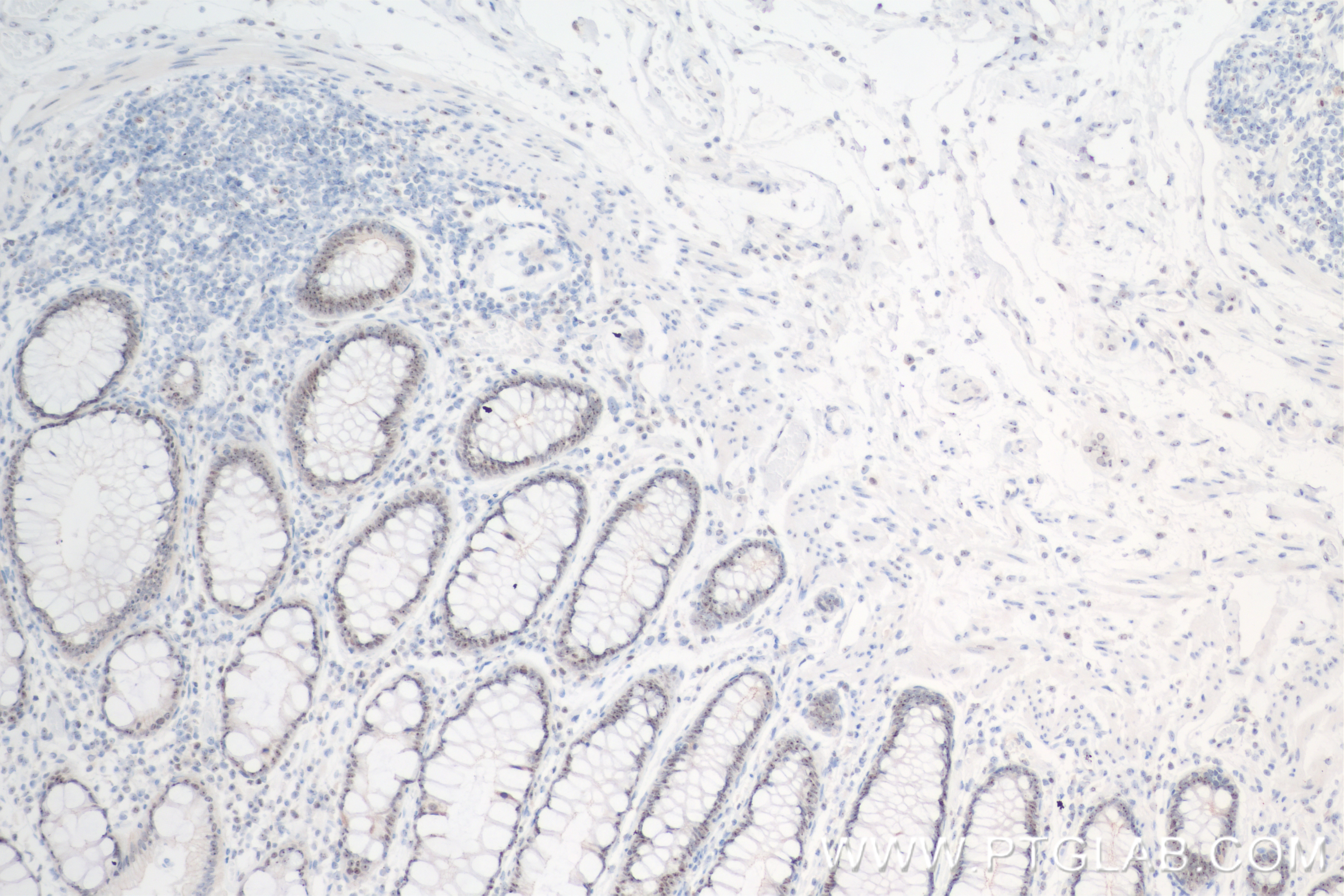 Immunohistochemistry (IHC) staining of human rectal cancer tissue using TERT Recombinant antibody (84636-1-RR)