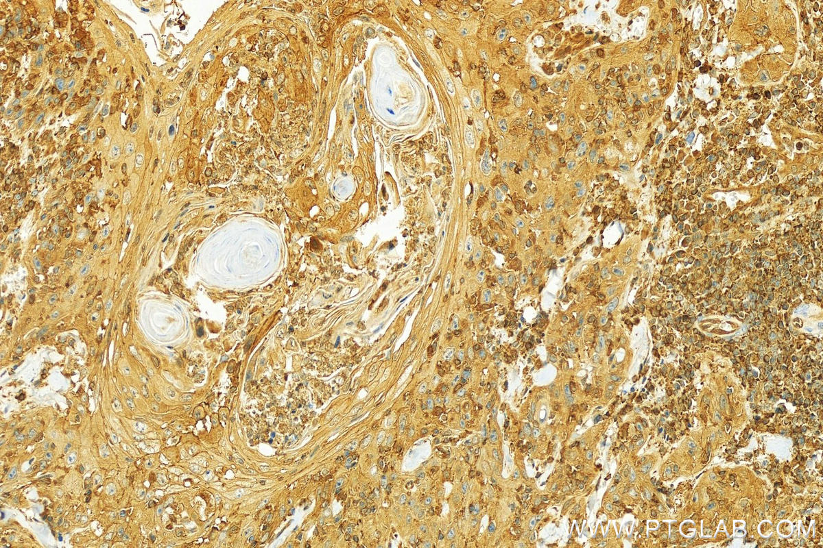 Immunohistochemistry (IHC) staining of human skin cancer tissue using TES Polyclonal antibody (10258-1-AP)