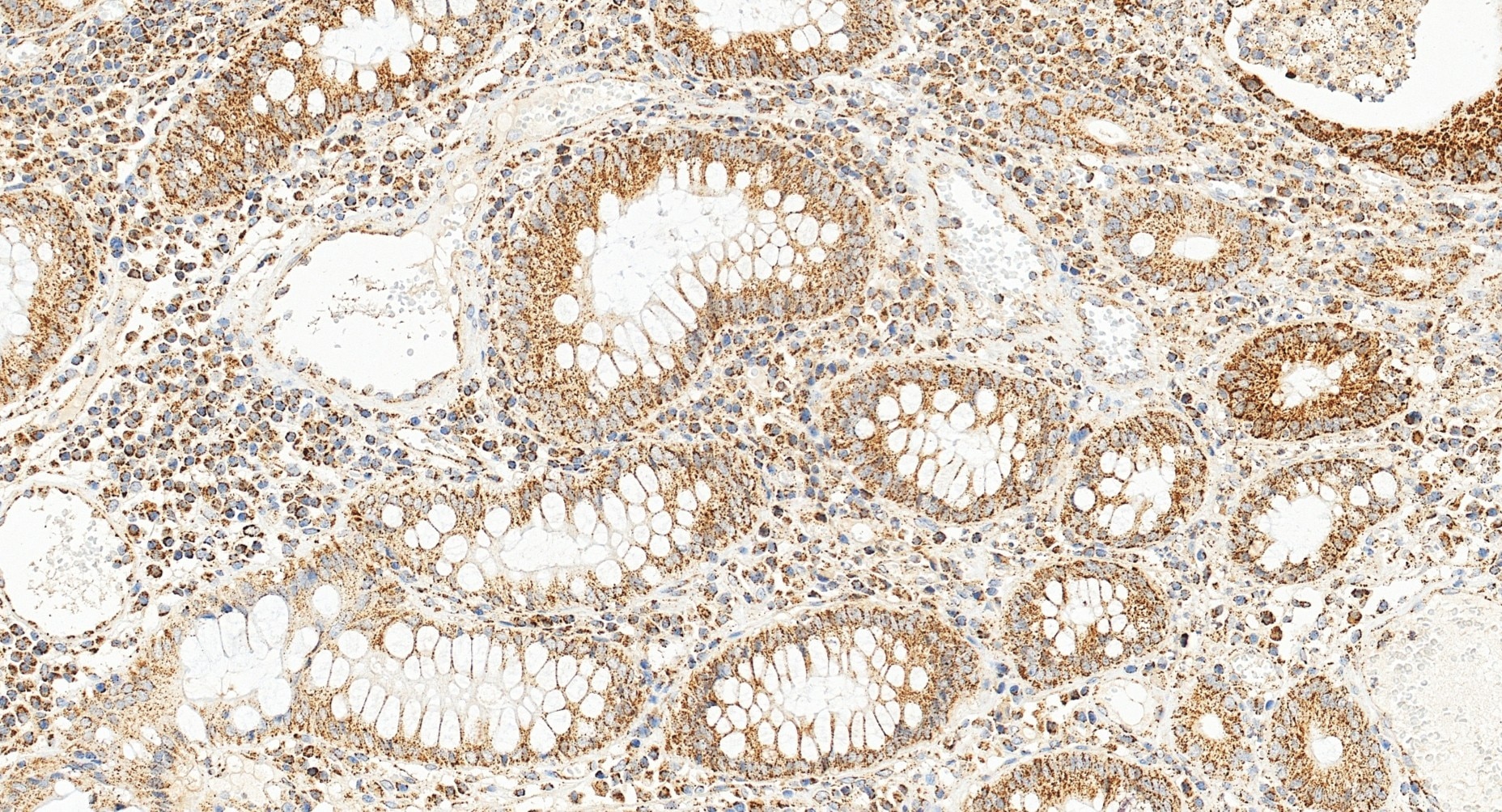 Immunohistochemistry (IHC) staining of human colon cancer tissue using TFAM Polyclonal antibody (22586-1-AP)