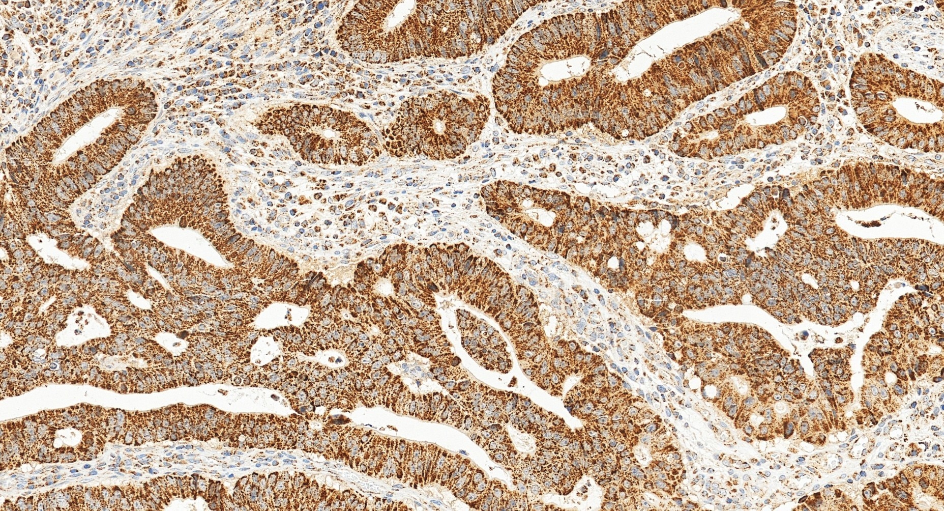 Immunohistochemistry (IHC) staining of human colon cancer tissue using TFAM Polyclonal antibody (22586-1-AP)
