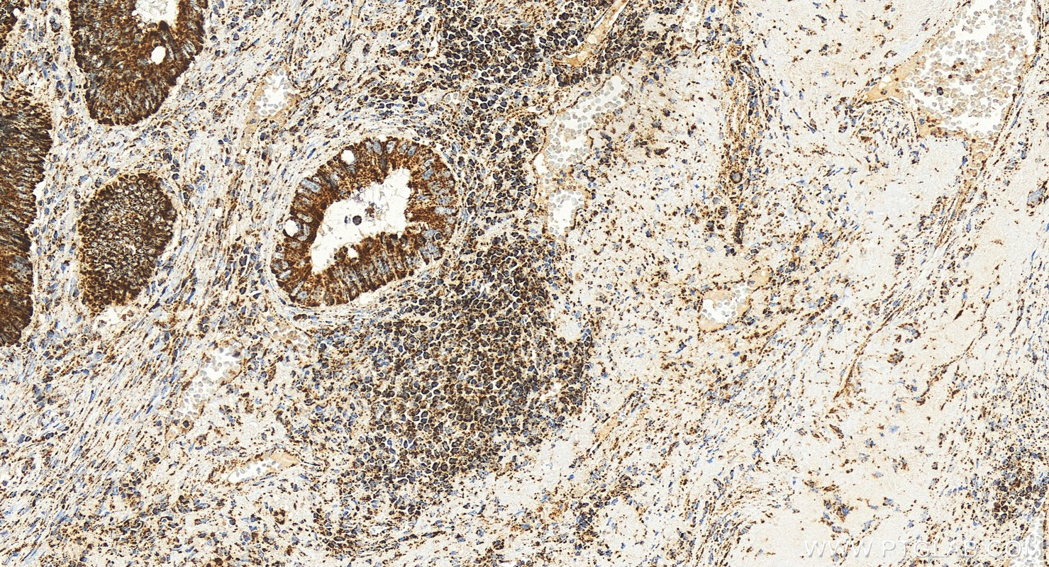 Immunohistochemistry (IHC) staining of human colon cancer tissue using TFAM Monoclonal antibody (68557-5-Ig)