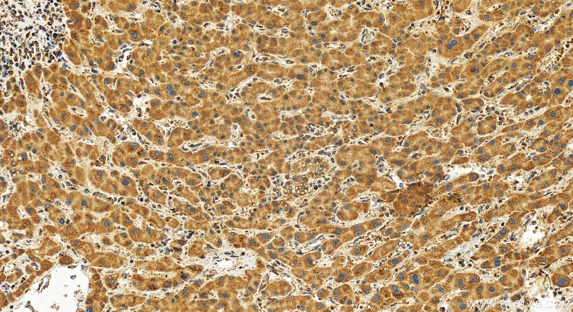 Immunohistochemistry (IHC) staining of human intrahepatic cholangiocarcinoma tissue using TFAM Recombinant antibody (82745-1-RR)