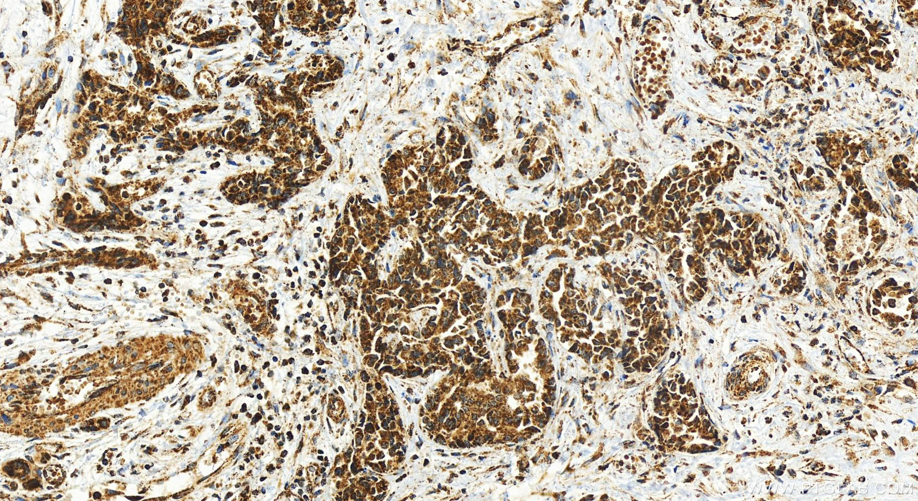 Immunohistochemistry (IHC) staining of human intrahepatic cholangiocarcinoma tissue using TFAM Recombinant antibody (82745-1-RR)