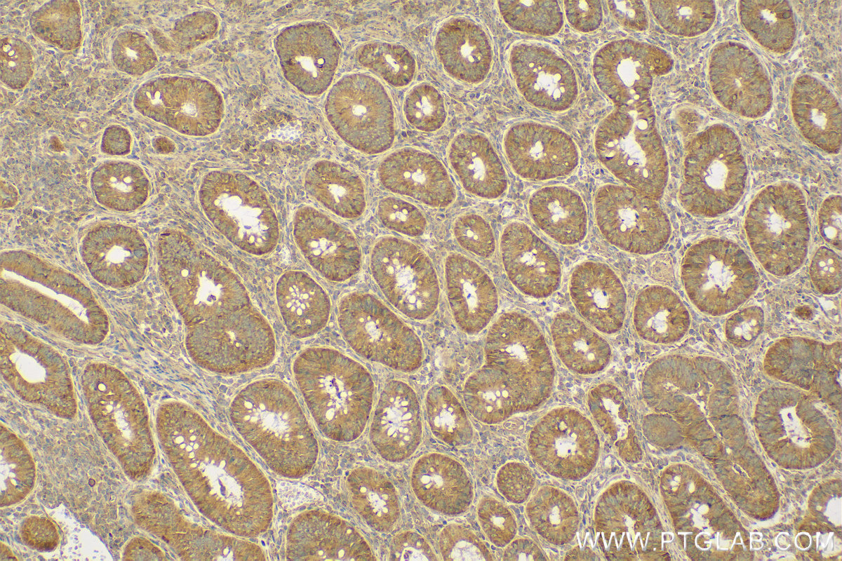 Immunohistochemistry (IHC) staining of human colon cancer tissue using TFF1 Polyclonal antibody (13734-1-AP)