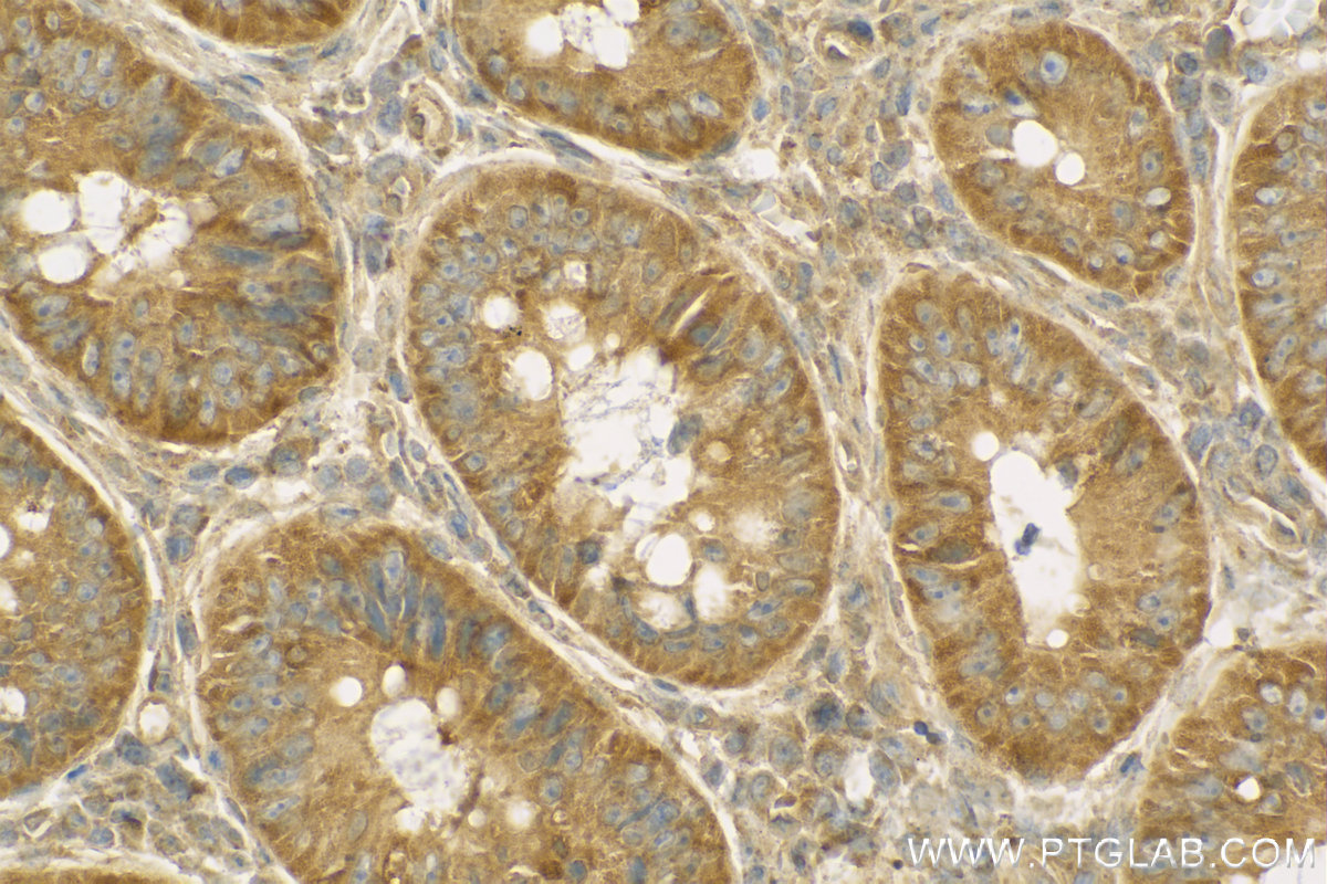 Immunohistochemistry (IHC) staining of human colon cancer tissue using TFF1 Polyclonal antibody (13734-1-AP)