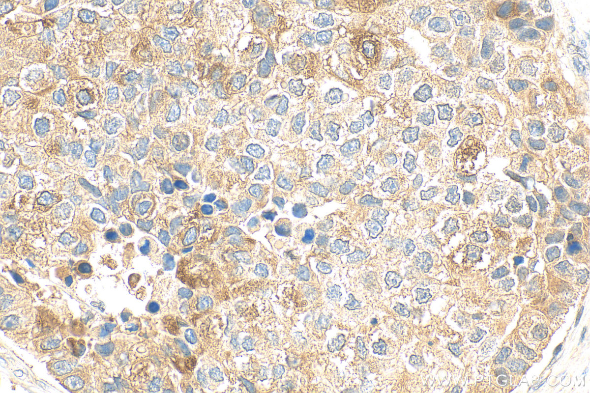 Immunohistochemistry (IHC) staining of human stomach cancer tissue using TFF1 Polyclonal antibody (13734-1-AP)