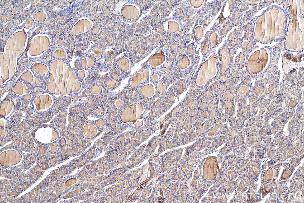 Immunohistochemistry (IHC) staining of human thyroid cancer tissue using Thyroglobulin Polyclonal antibody (21714-1-AP)