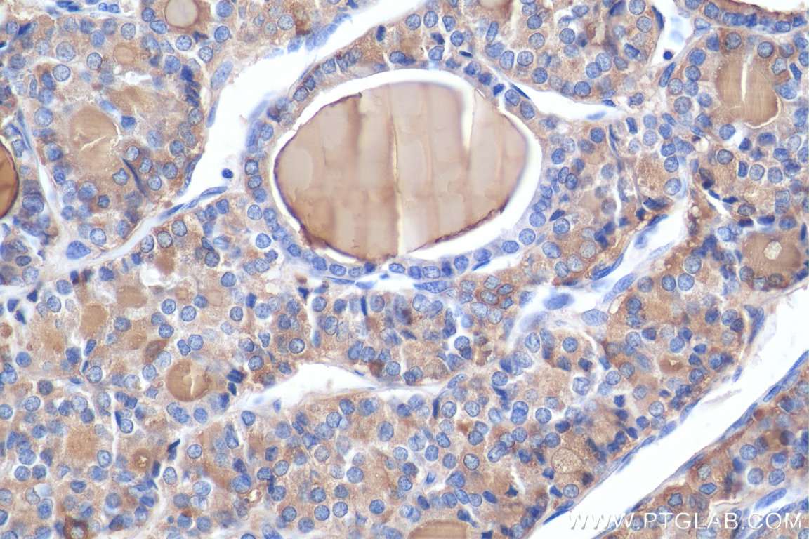 Immunohistochemistry (IHC) staining of human thyroid cancer tissue using Thyroglobulin Polyclonal antibody (21714-1-AP)