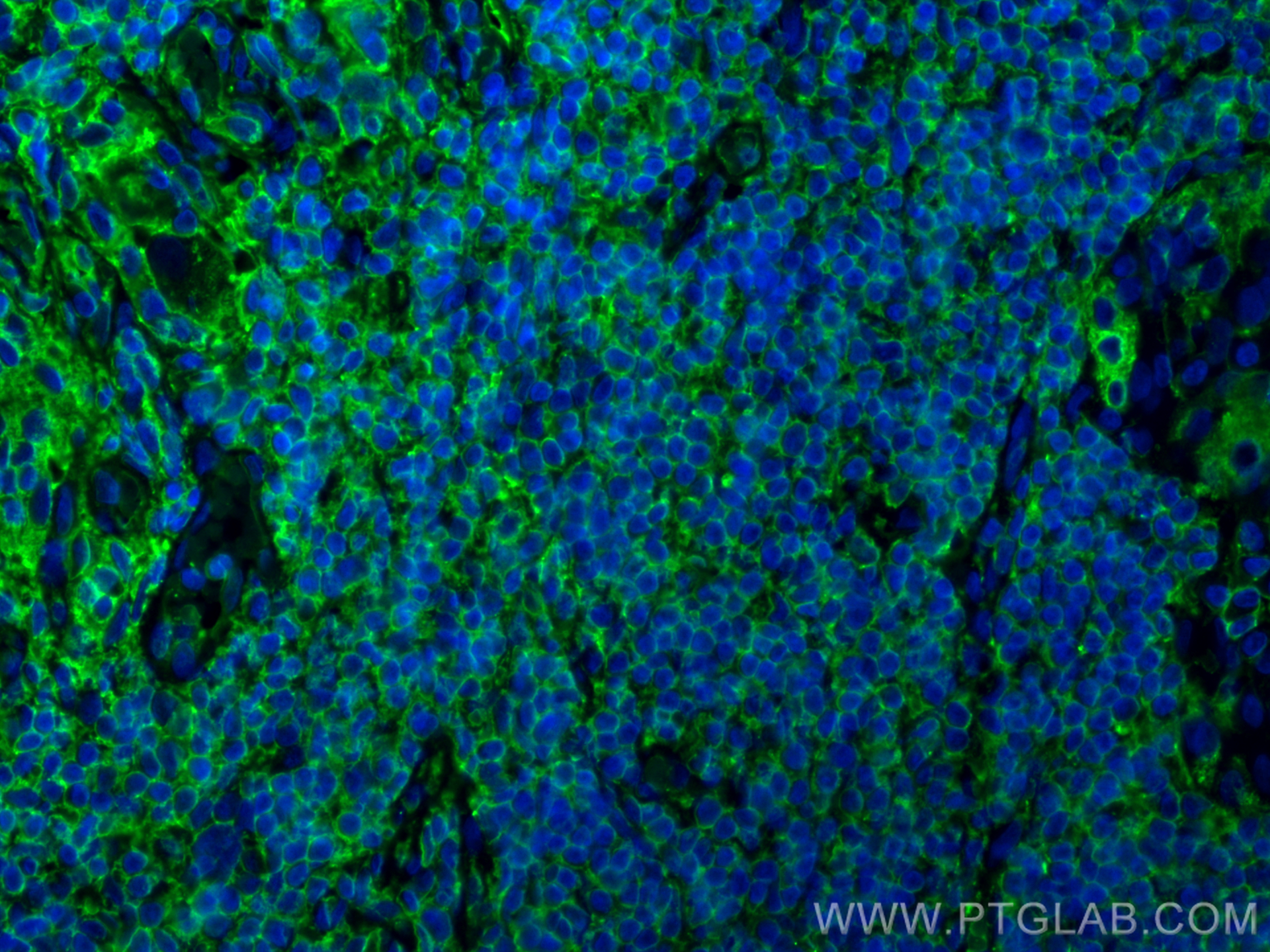 Immunofluorescence (IF) / fluorescent staining of human thyroid cancer tissue using Thyroglobulin Monoclonal antibody (60272-1-Ig)