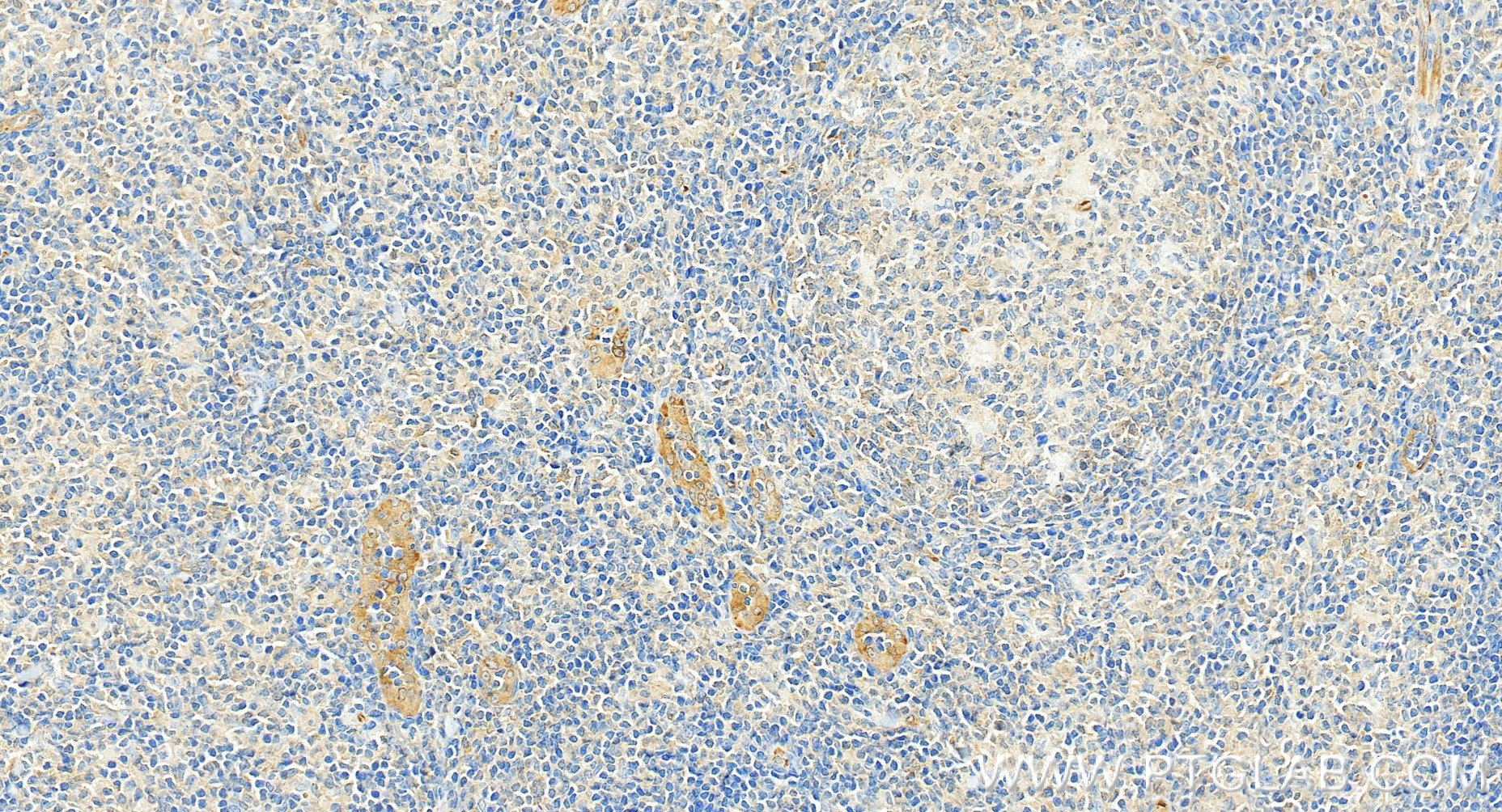 Immunohistochemistry (IHC) staining of human tonsillitis tissue using TGF Beta 1 Recombinant monoclonal antibody (81746-2-RR)