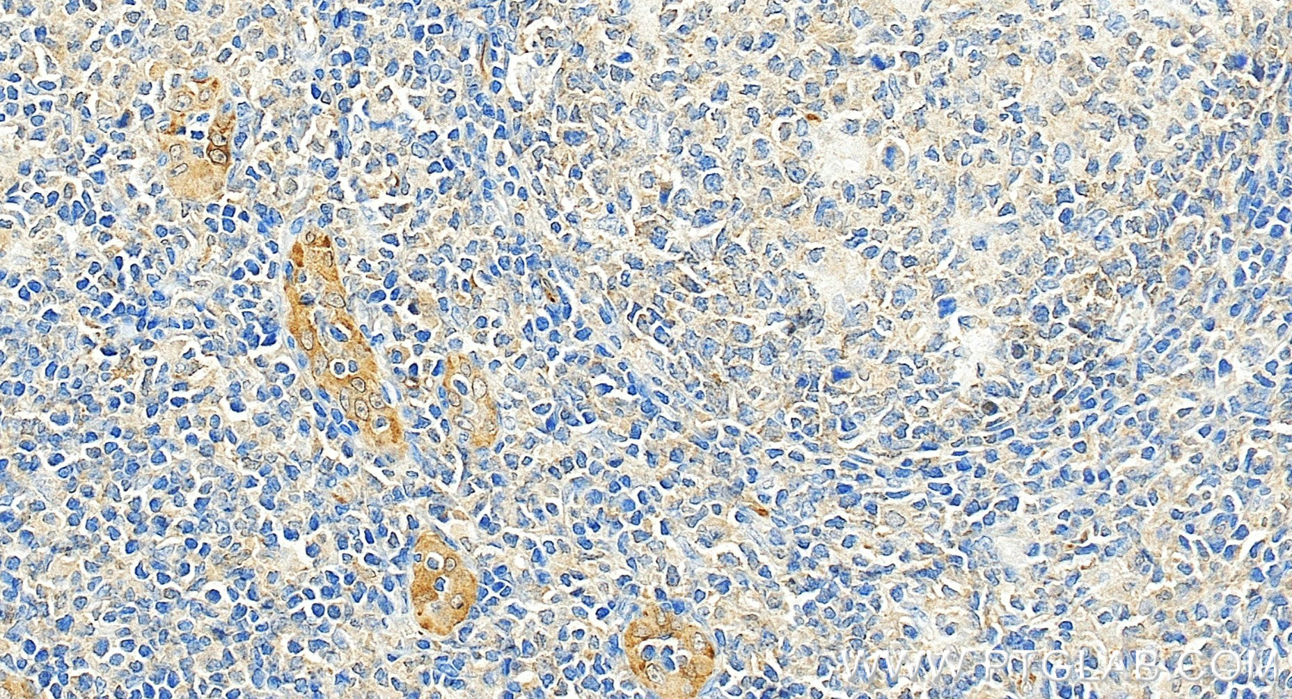 Immunohistochemistry (IHC) staining of human tonsillitis tissue using TGF Beta 1 Recombinant monoclonal antibody (81746-2-RR)