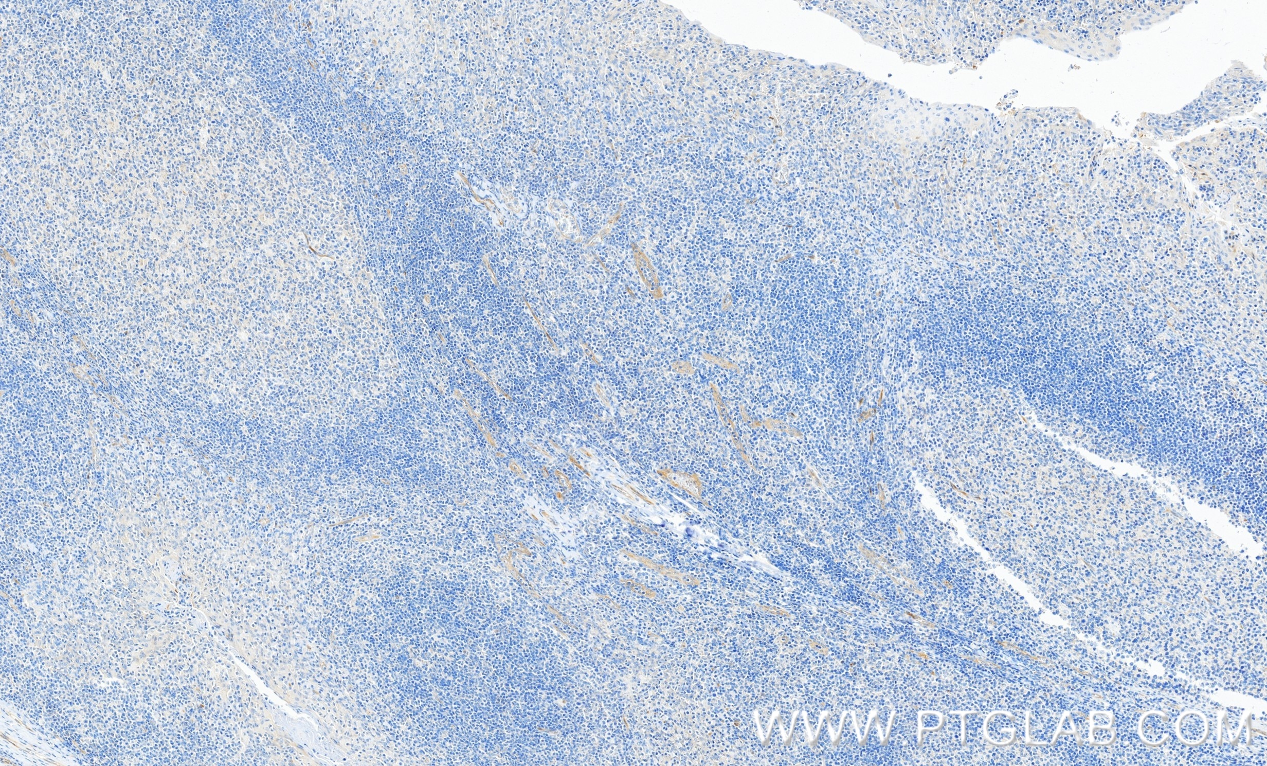 Immunohistochemistry (IHC) staining of human tonsillitis tissue using TGF Beta 1 Recombinant monoclonal antibody (81746-2-RR)