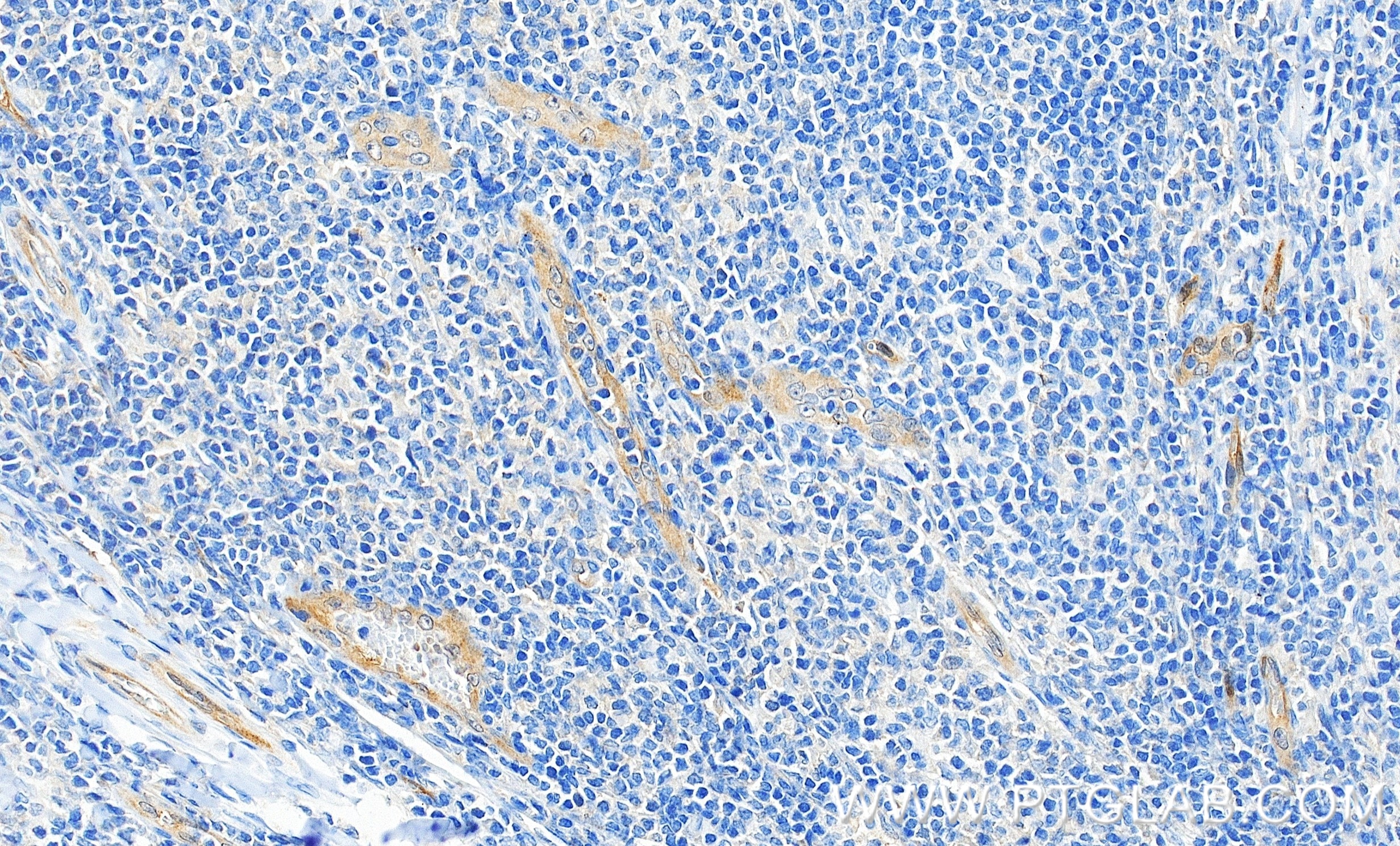Immunohistochemistry (IHC) staining of human tonsillitis tissue using TGF Beta 1 Recombinant monoclonal antibody (81746-2-RR)