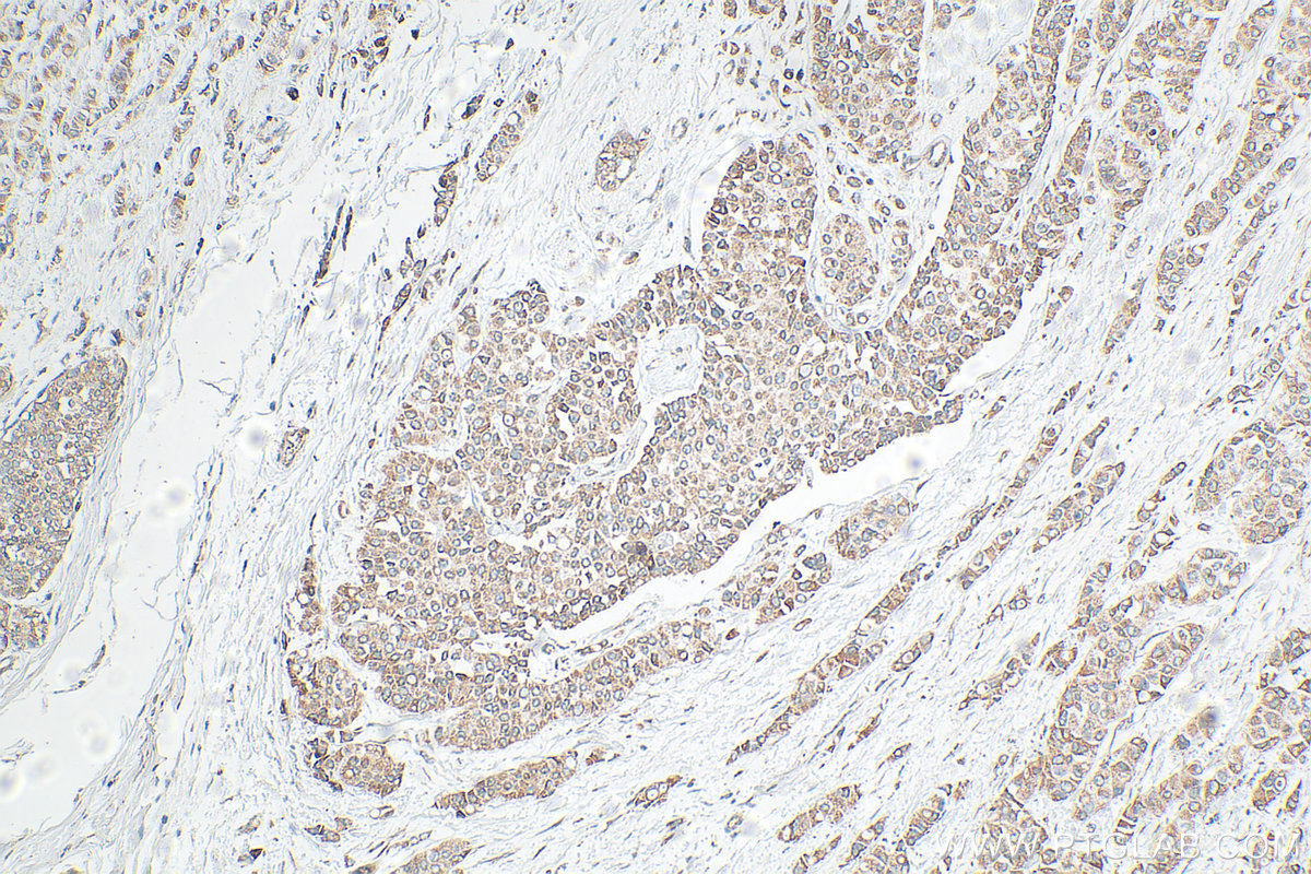 Immunohistochemistry (IHC) staining of human breast cancer tissue using TGF beta 2-Specific Polyclonal antibody (19999-1-AP)