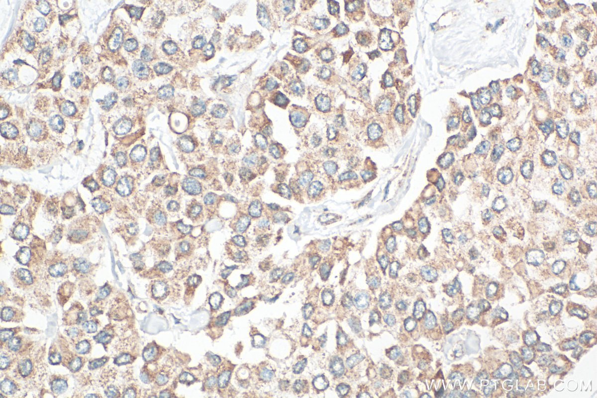 Immunohistochemistry (IHC) staining of human breast cancer tissue using TGF beta 2-Specific Polyclonal antibody (19999-1-AP)