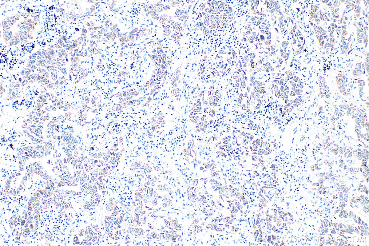 Immunohistochemistry (IHC) staining of human lung cancer tissue using TGF beta 2-Specific Polyclonal antibody (19999-1-AP)