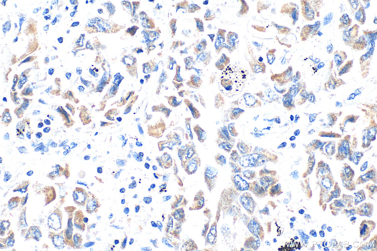 Immunohistochemistry (IHC) staining of human lung cancer tissue using TGF beta 2-Specific Polyclonal antibody (19999-1-AP)