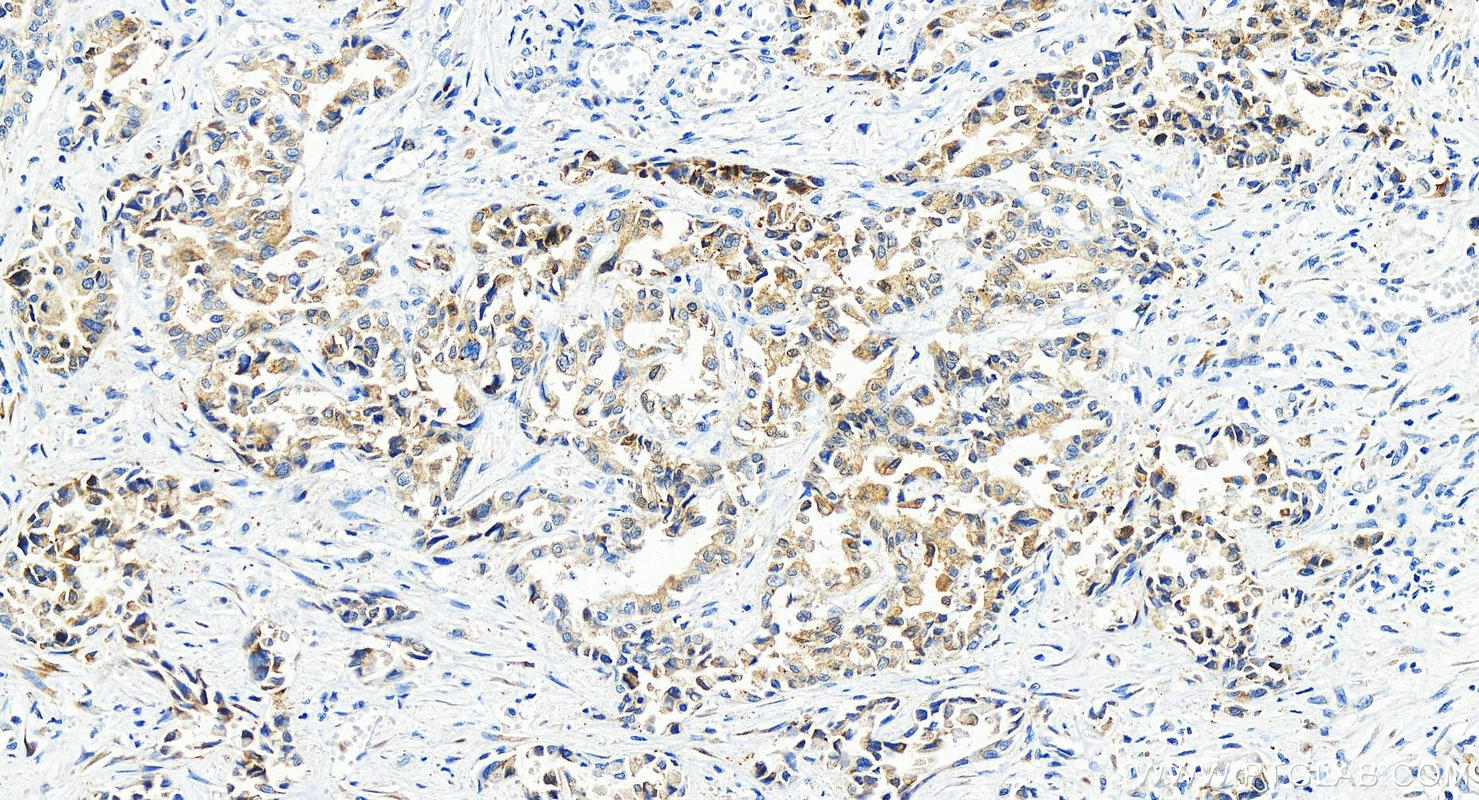 Immunohistochemistry (IHC) staining of human intrahepatic cholangiocarcinoma tissue using TGFB2/TGF-beta 2 Recombinant antibody (83167-5-RR)