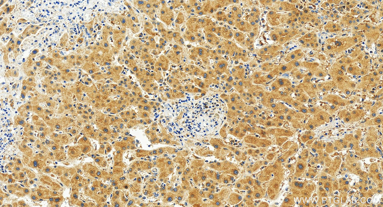 Immunohistochemistry (IHC) staining of human intrahepatic cholangiocarcinoma tissue using TGFB2/TGF-beta 2 Recombinant antibody (83167-5-RR)