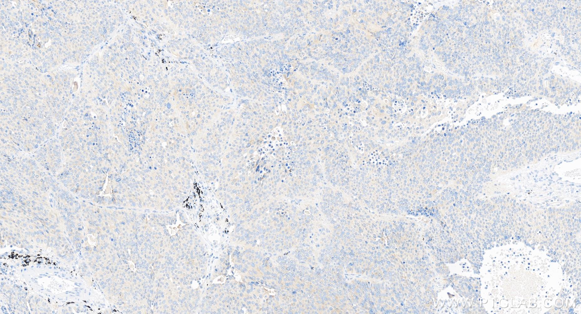 Immunohistochemistry (IHC) staining of human lung cancer tissue using TGFBR1 Recombinant antibody (84453-1-RR)