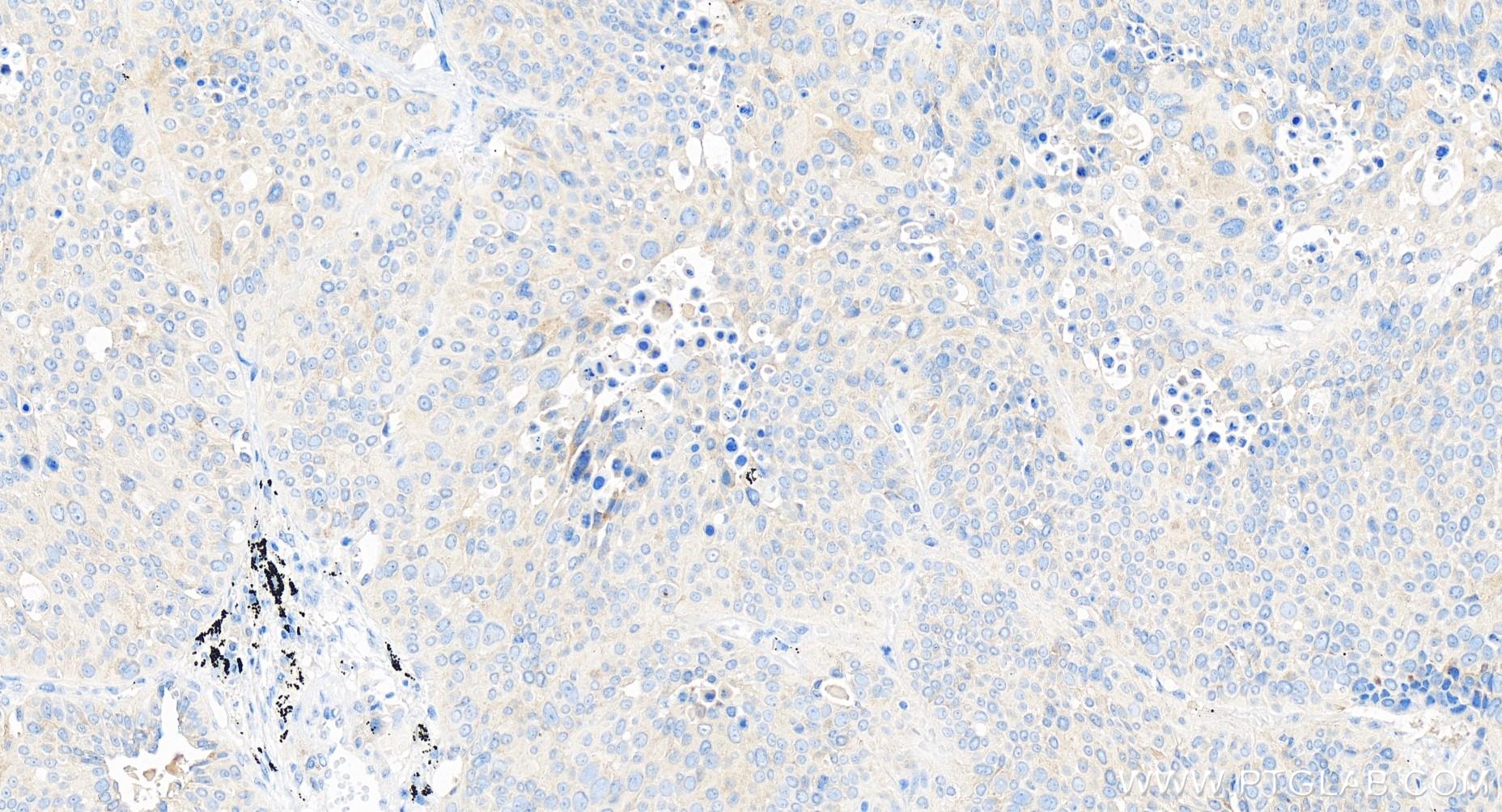 Immunohistochemistry (IHC) staining of human lung cancer tissue using TGFBR1 Recombinant antibody (84453-1-RR)