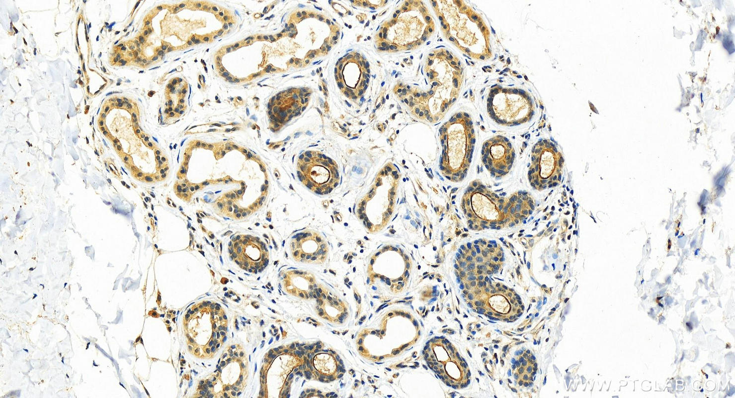 Immunohistochemistry (IHC) staining of human bowen disease using TGM1 Polyclonal antibody (12912-3-AP)