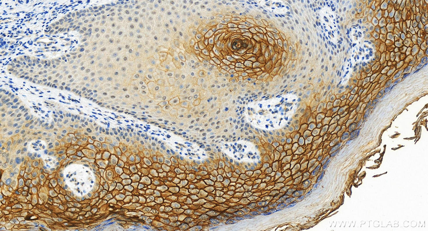 Immunohistochemistry (IHC) staining of human bowen disease using TGM1 Polyclonal antibody (12912-3-AP)