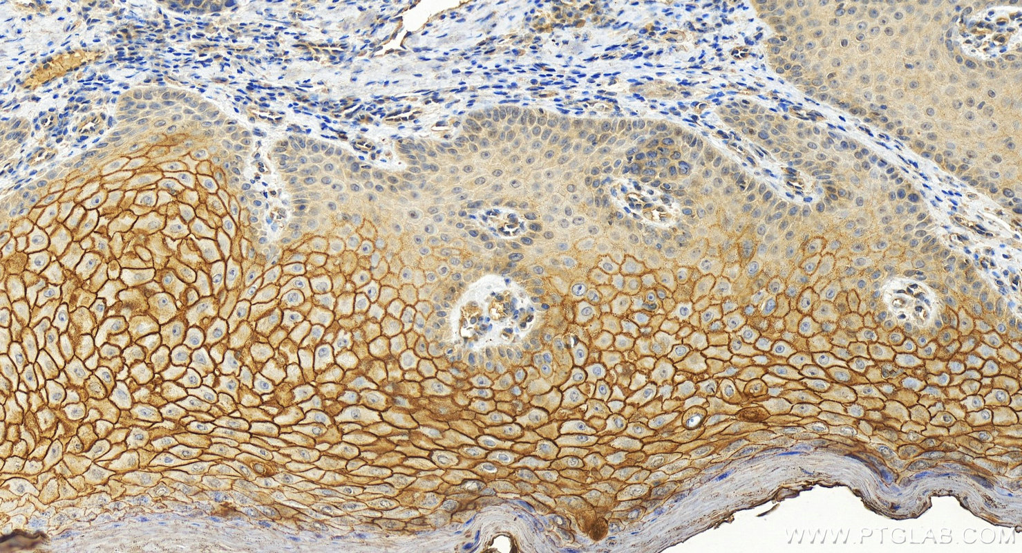 Immunohistochemistry (IHC) staining of human brown disease using TGM1 Polyclonal antibody (12912-3-AP)