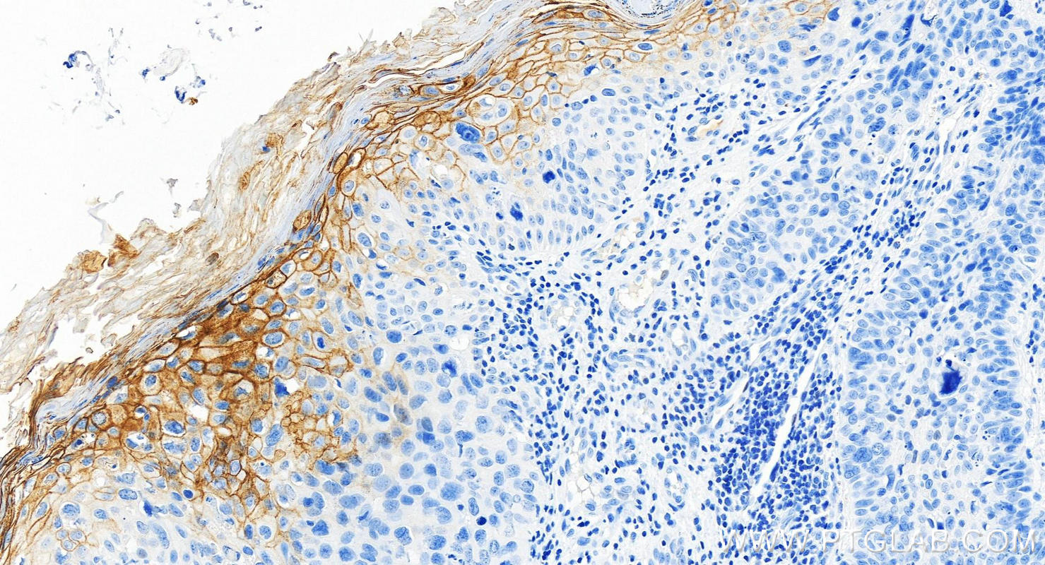 Immunohistochemistry (IHC) staining of human bowen disease using TGM1 Recombinant antibody (84032-2-RR)