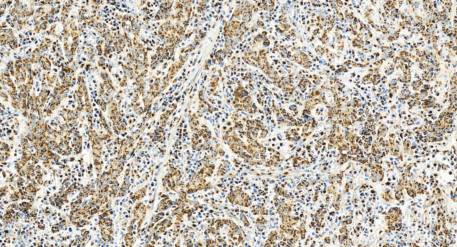 Immunohistochemistry (IHC) staining of human stomach cancer tissue using TGOLN2,TGN46 Recombinant antibody (83099-2-RR)