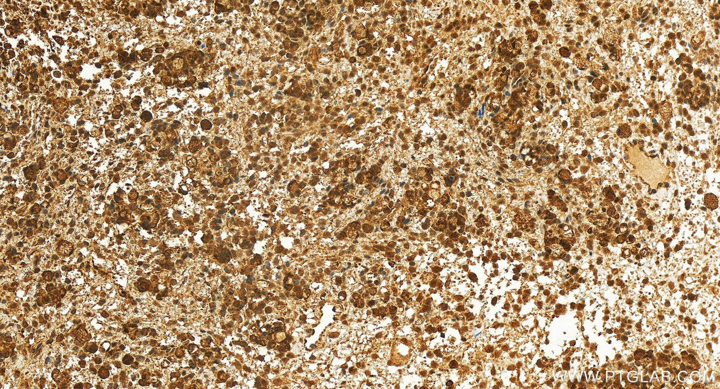 Immunohistochemistry (IHC) staining of human ovary cancer tissue using TGS1 Polyclonal antibody (13034-1-AP)