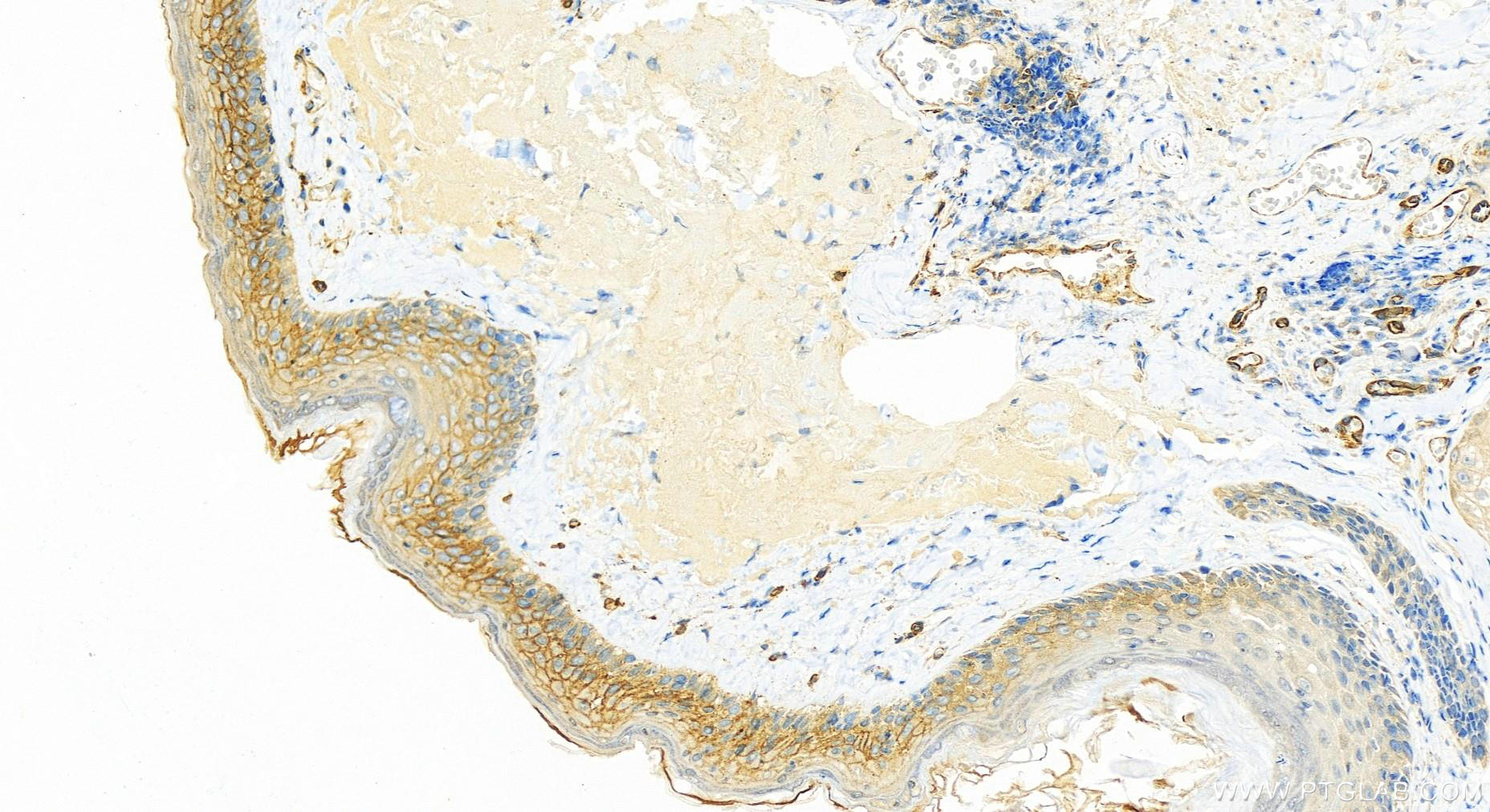 Immunohistochemistry (IHC) staining of human skin cancer tissue using CD141/Thrombomodulin Polyclonal antibody (14318-1-AP)