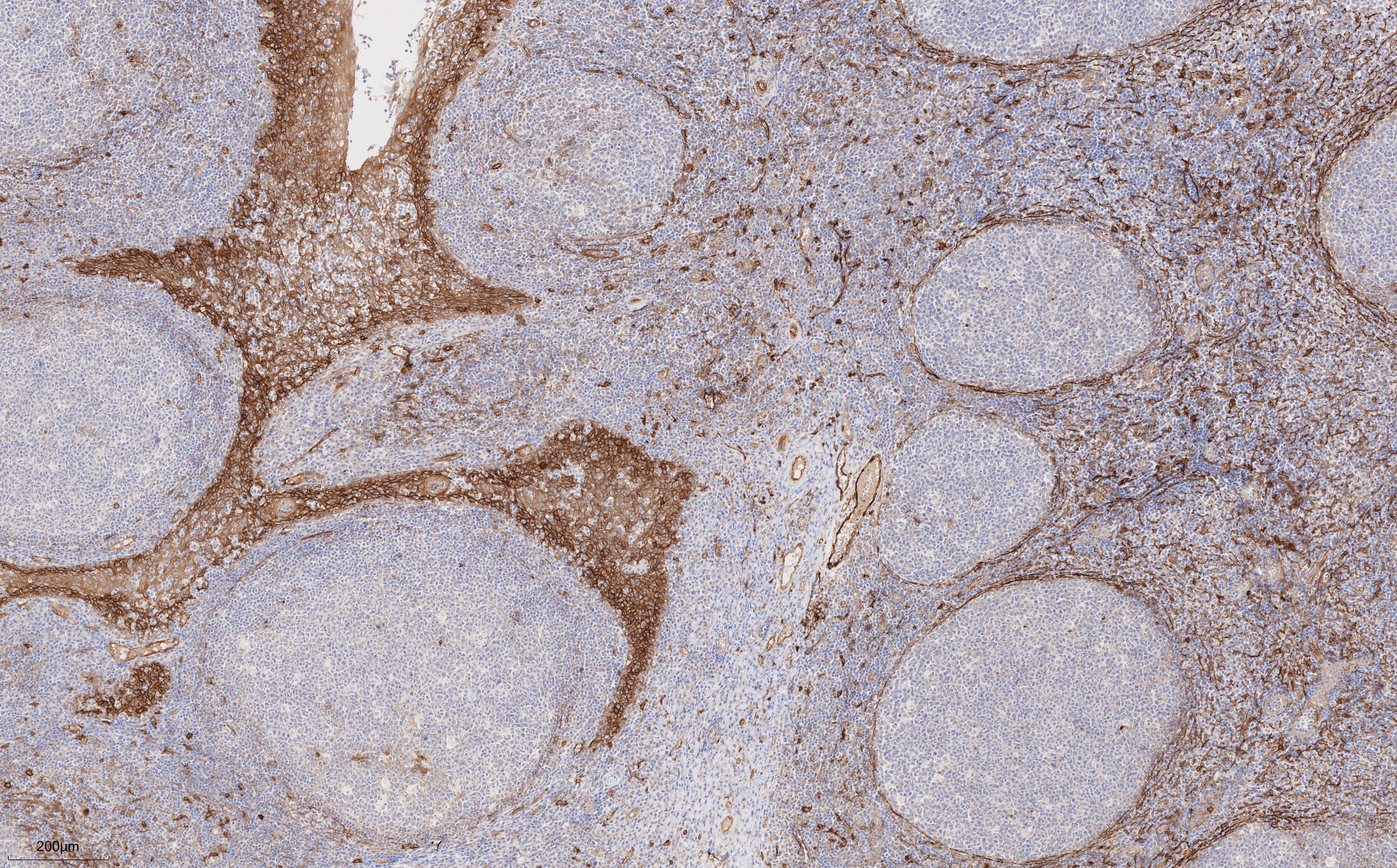 Immunohistochemistry (IHC) staining of human tonsillitis tissue using CD141/Thrombomodulin Monoclonal antibody (67831-1-Ig)