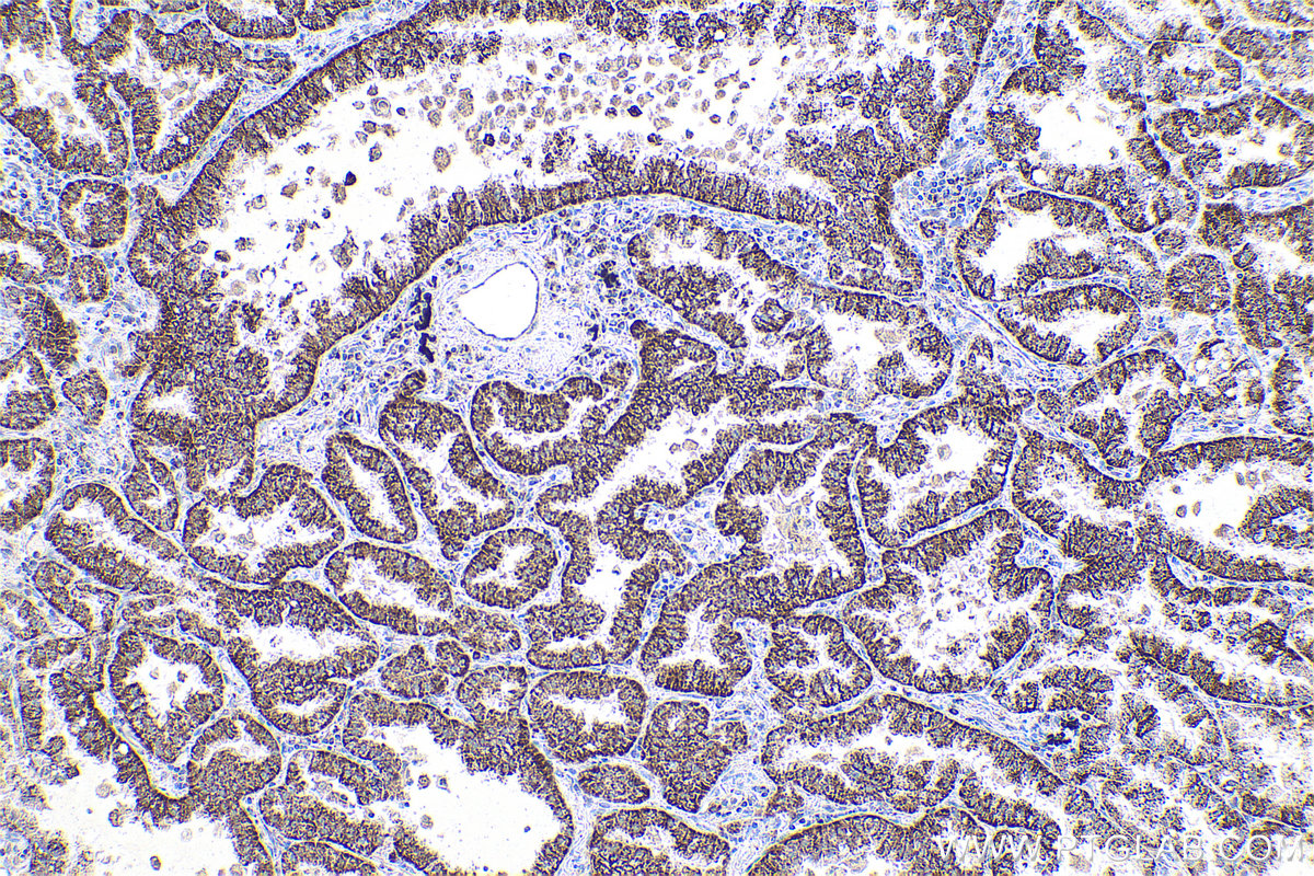 Immunohistochemistry (IHC) staining of human lung cancer tissue using THEM2 Polyclonal antibody (16782-1-AP)