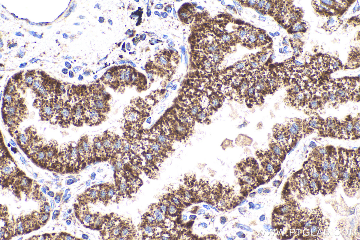 Immunohistochemistry (IHC) staining of human lung cancer tissue using THEM2 Polyclonal antibody (16782-1-AP)