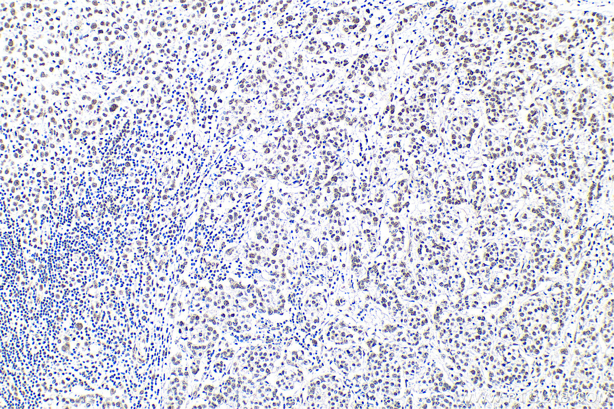 Immunohistochemistry (IHC) staining of human breast cancer tissue using THOC5 Polyclonal antibody (14862-1-AP)