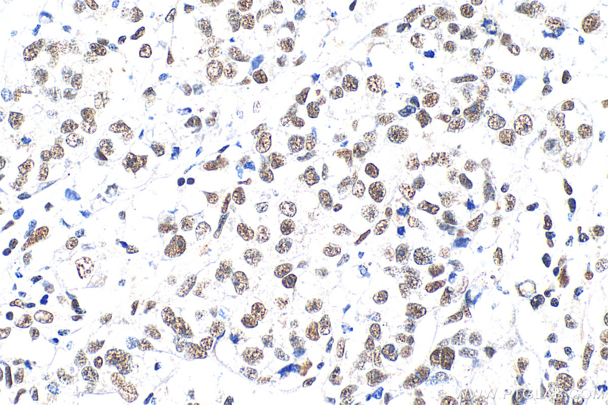 Immunohistochemistry (IHC) staining of human breast cancer tissue using THOC5 Polyclonal antibody (14862-1-AP)