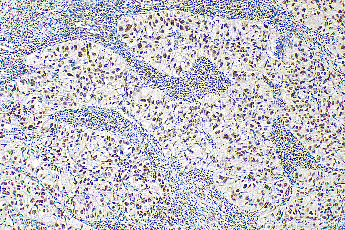 Immunohistochemistry (IHC) staining of human lung cancer tissue using THOC5 Polyclonal antibody (14862-1-AP)