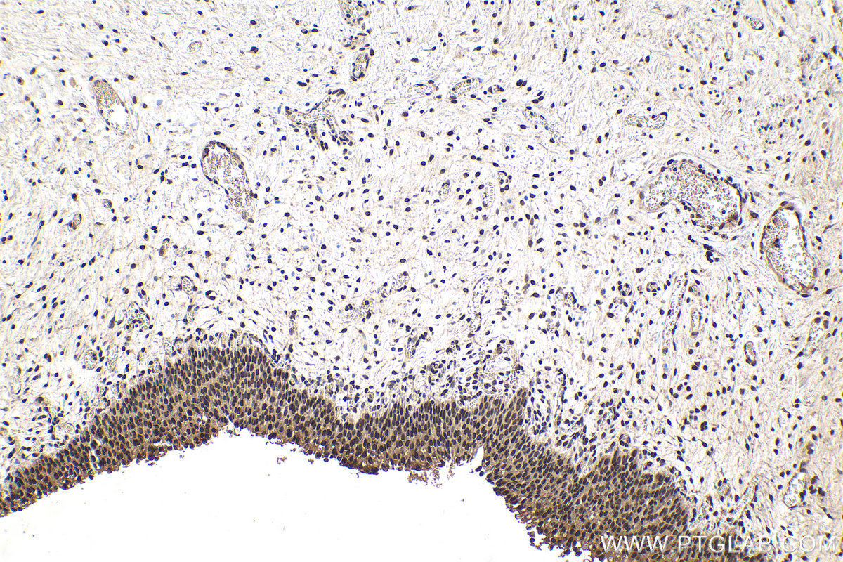 Immunohistochemistry (IHC) staining of human urothelial carcinoma tissue using TIA1 Monoclonal antibody (68486-1-Ig)