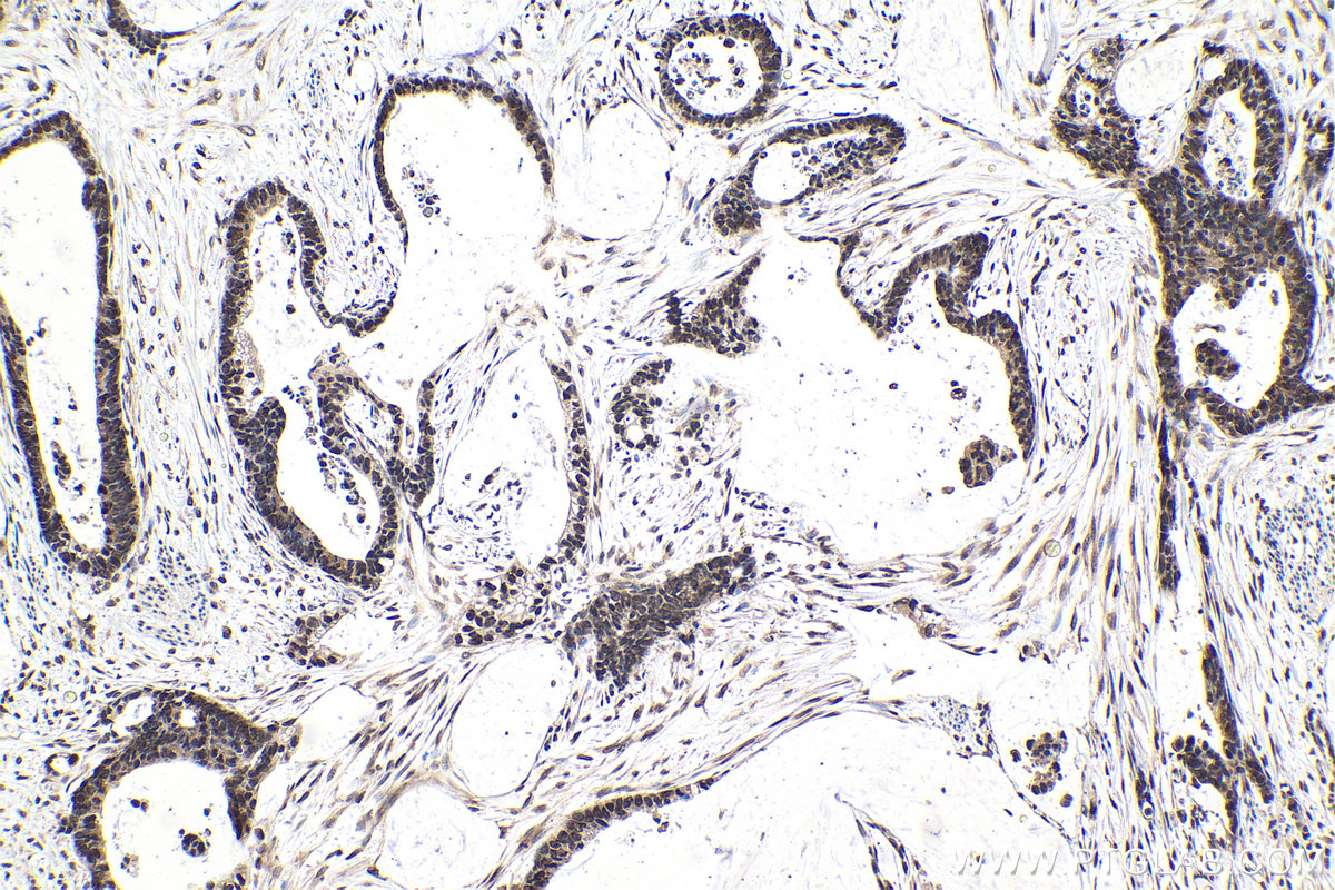 Immunohistochemistry (IHC) staining of human urothelial carcinoma tissue using TIA1 Monoclonal antibody (68486-1-Ig)