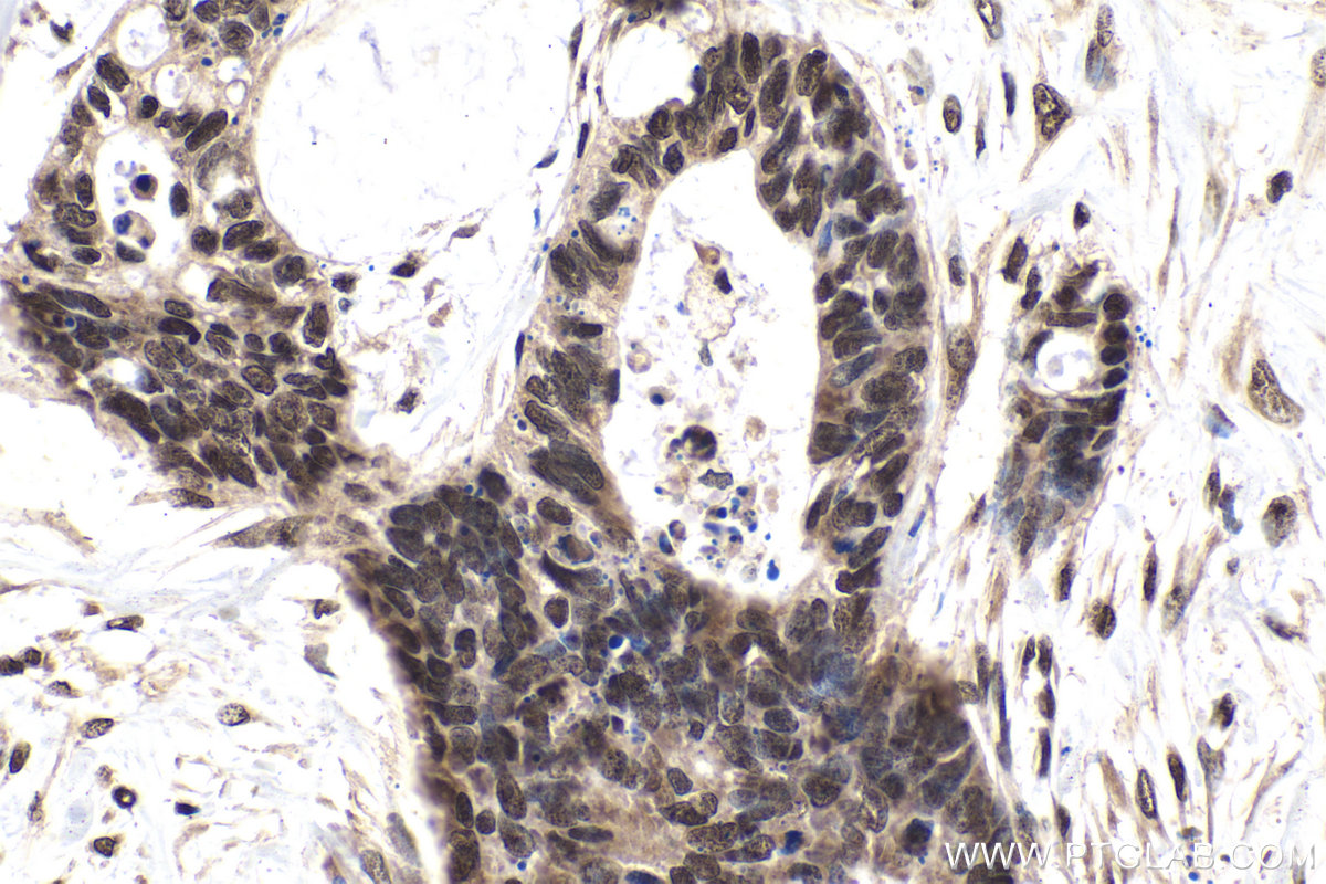 Immunohistochemistry (IHC) staining of human urothelial carcinoma tissue using TIA1 Monoclonal antibody (68486-1-Ig)