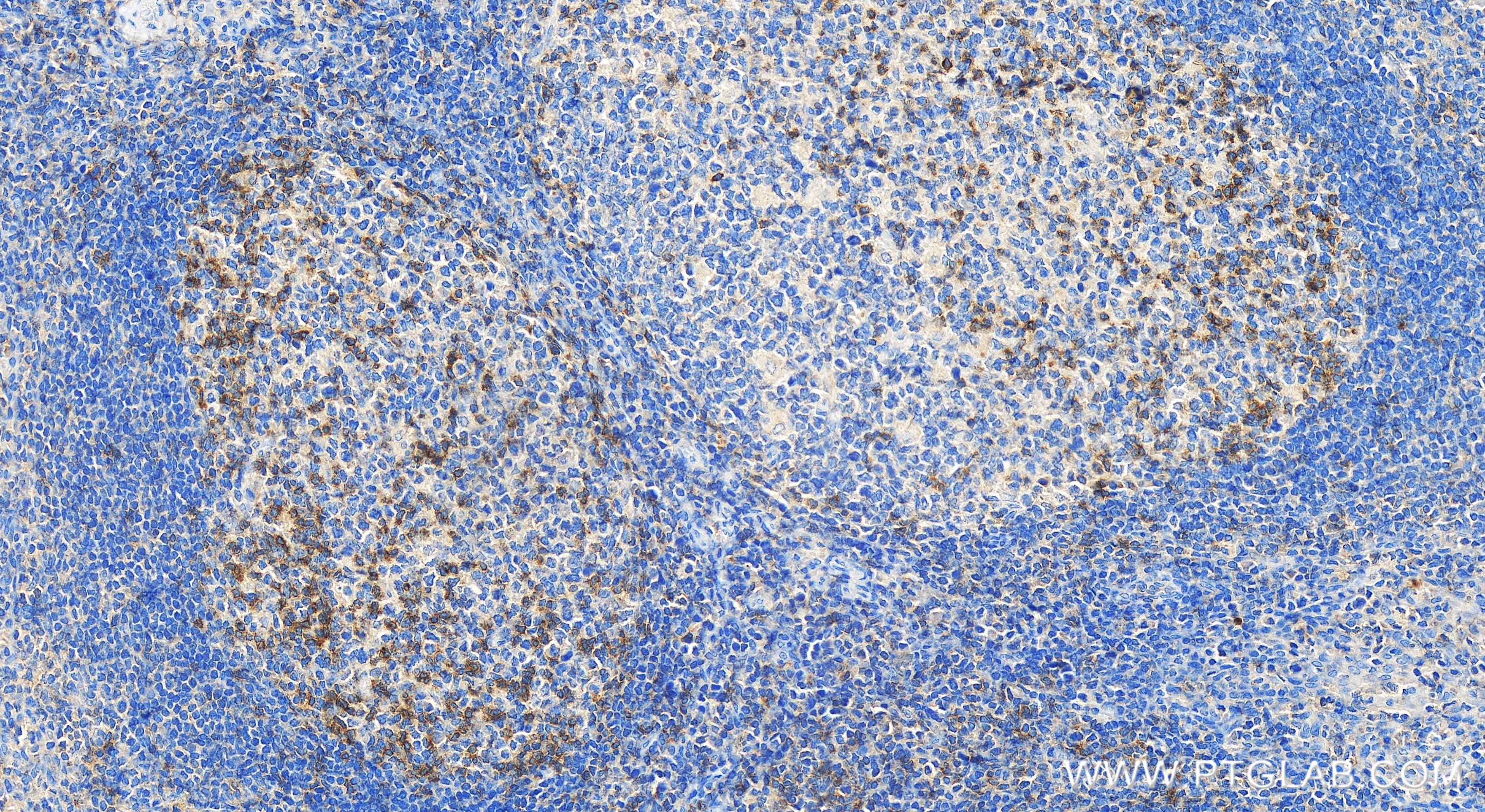 Immunohistochemistry (IHC) staining of human tonsillitis tissue using TIGIT Recombinant antibody (83545-1-RR)