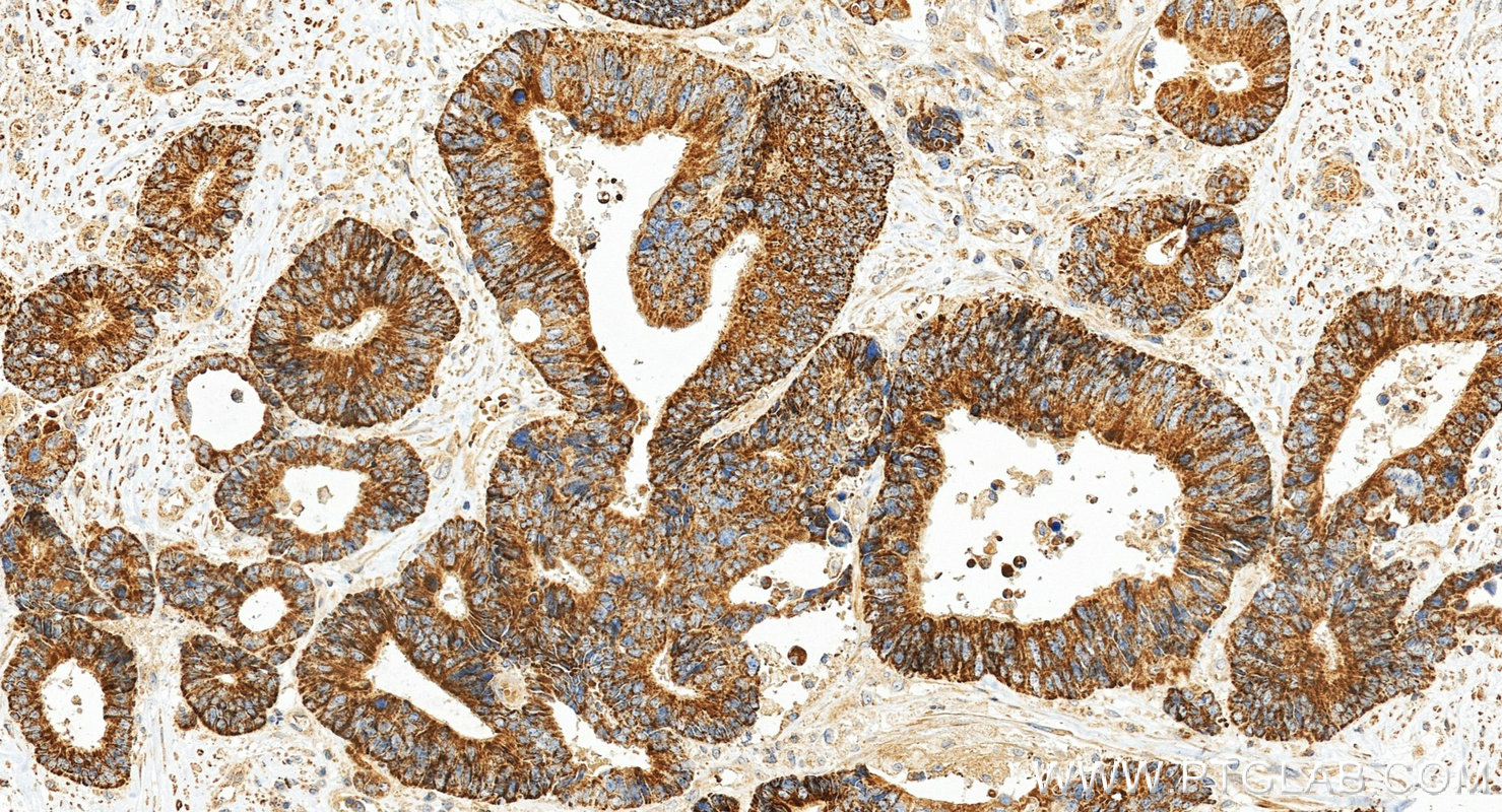 Immunohistochemistry (IHC) staining of human colon cancer tissue using TIMM17B Polyclonal antibody (11062-1-AP)