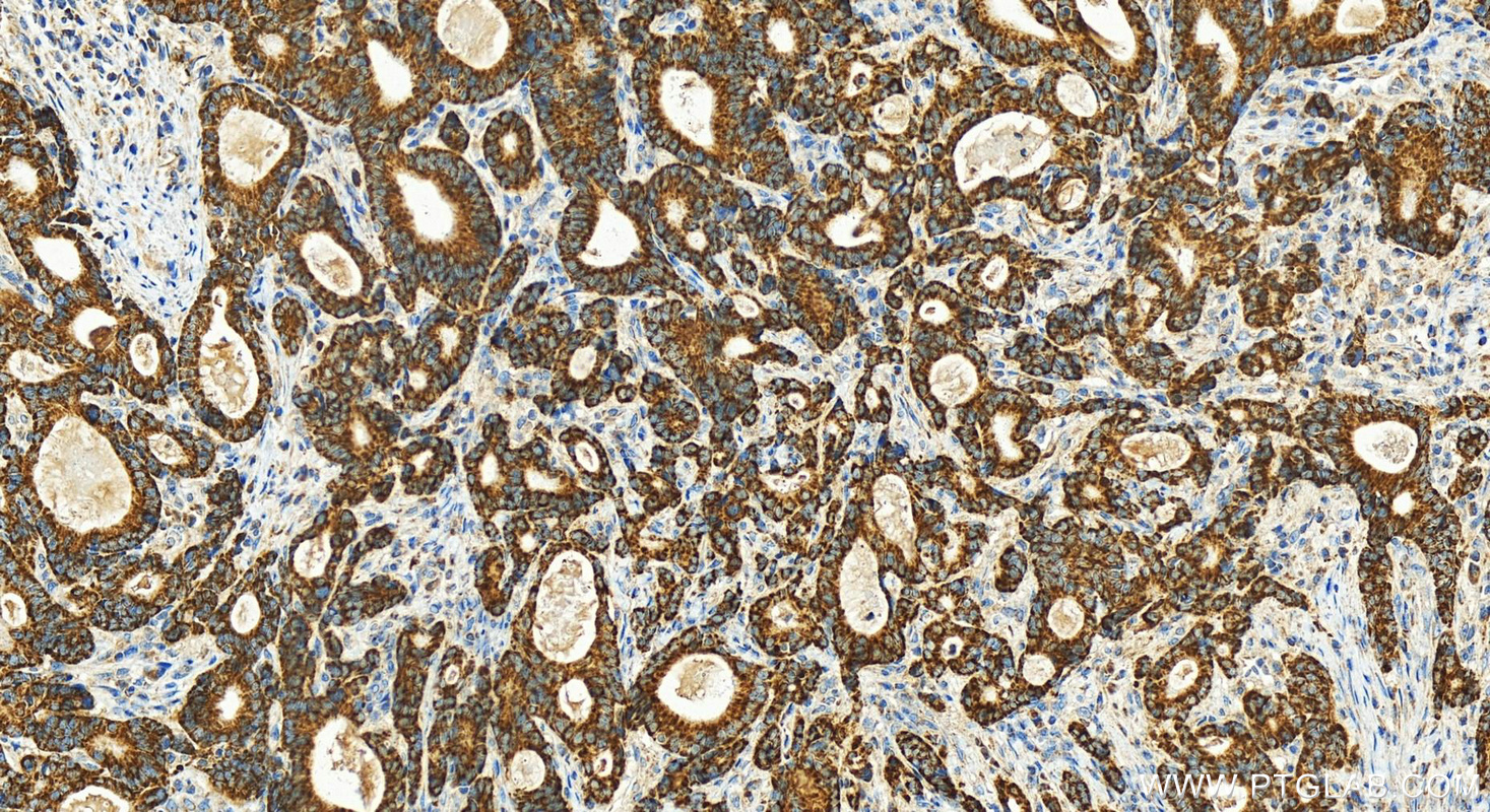 Immunohistochemistry (IHC) staining of human stomach cancer tissue using TIMM8A Polyclonal antibody (11179-1-AP)