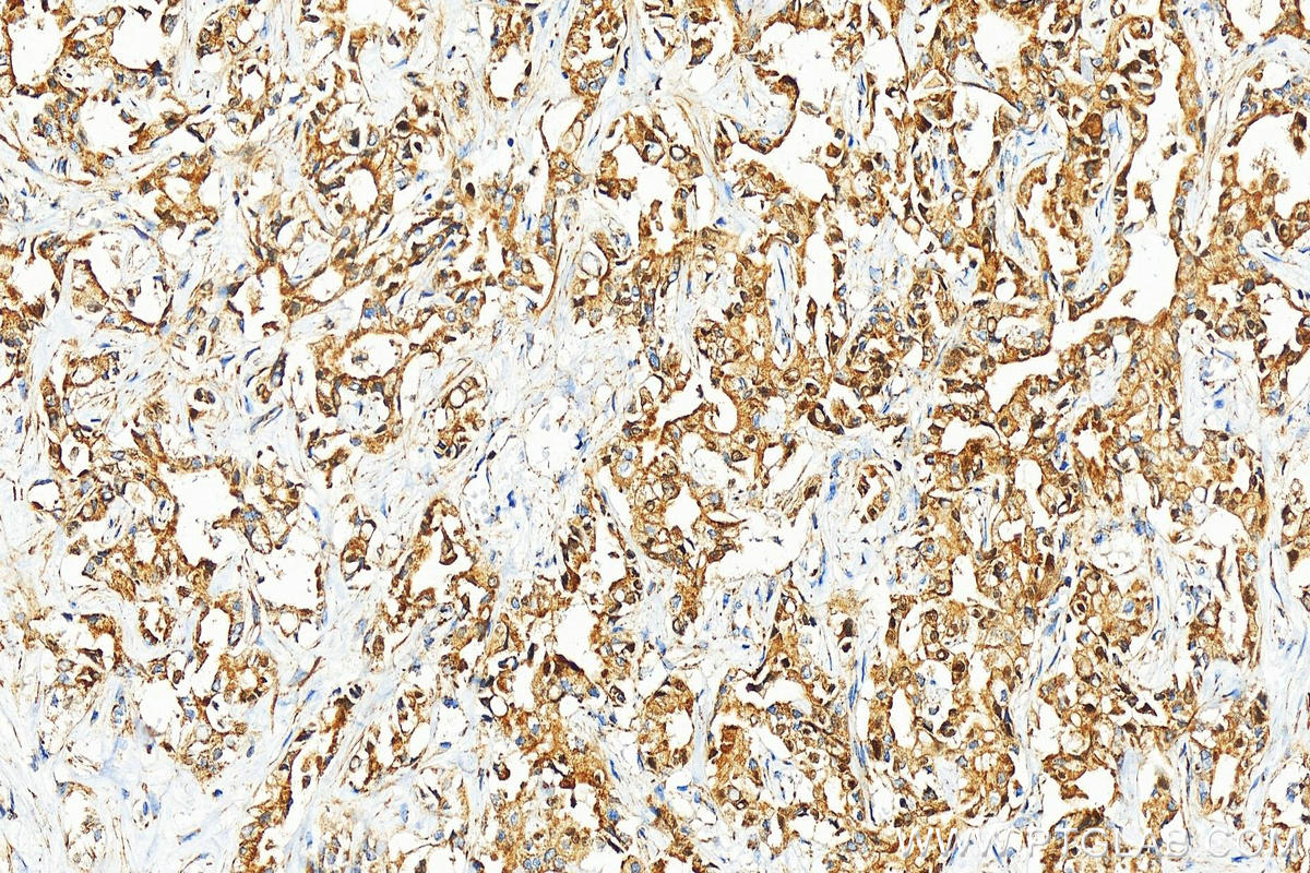 Immunohistochemistry (IHC) staining of human intrahepatic cholangiocarcinoma tissue using TIMM8A Polyclonal antibody (11179-1-AP)