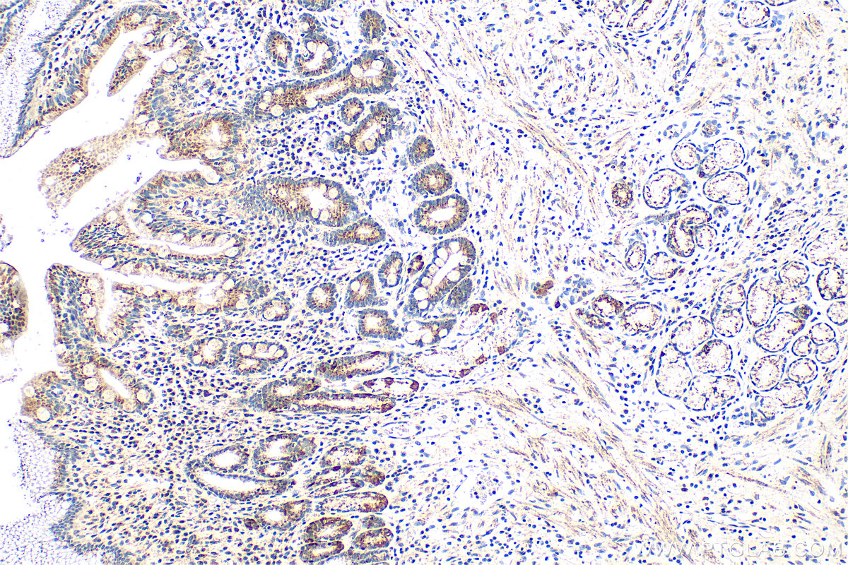 Immunohistochemistry (IHC) staining of human stomach cancer tissue using TIMM9 Polyclonal antibody (11479-1-AP)