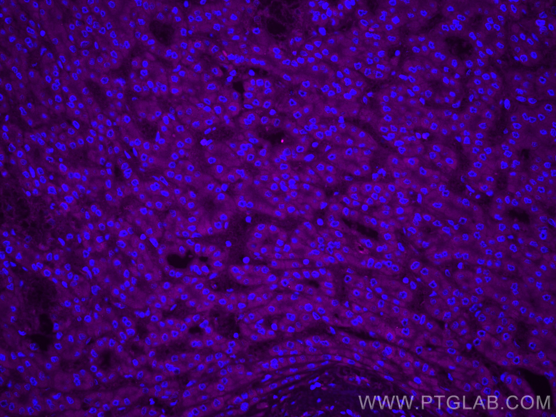Immunofluorescence (IF) / fluorescent staining of human liver cancer tissue using CoraLite® Plus 647-conjugated TINAGL1 Polyclonal a (CL647-12077)