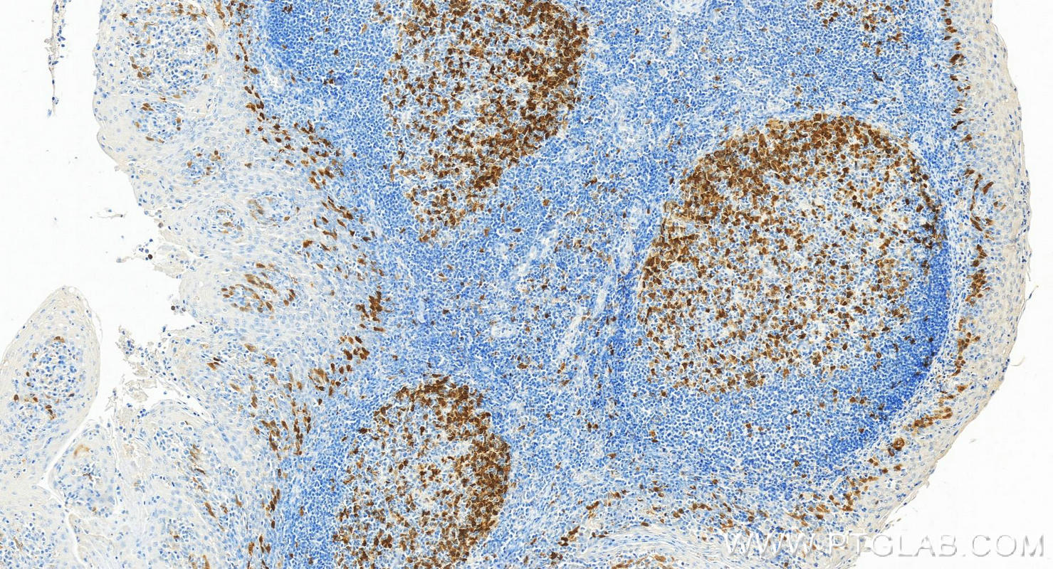 Immunohistochemistry (IHC) staining of human tonsillitis tissue using TK1 Monoclonal antibody (67787-1-Ig)