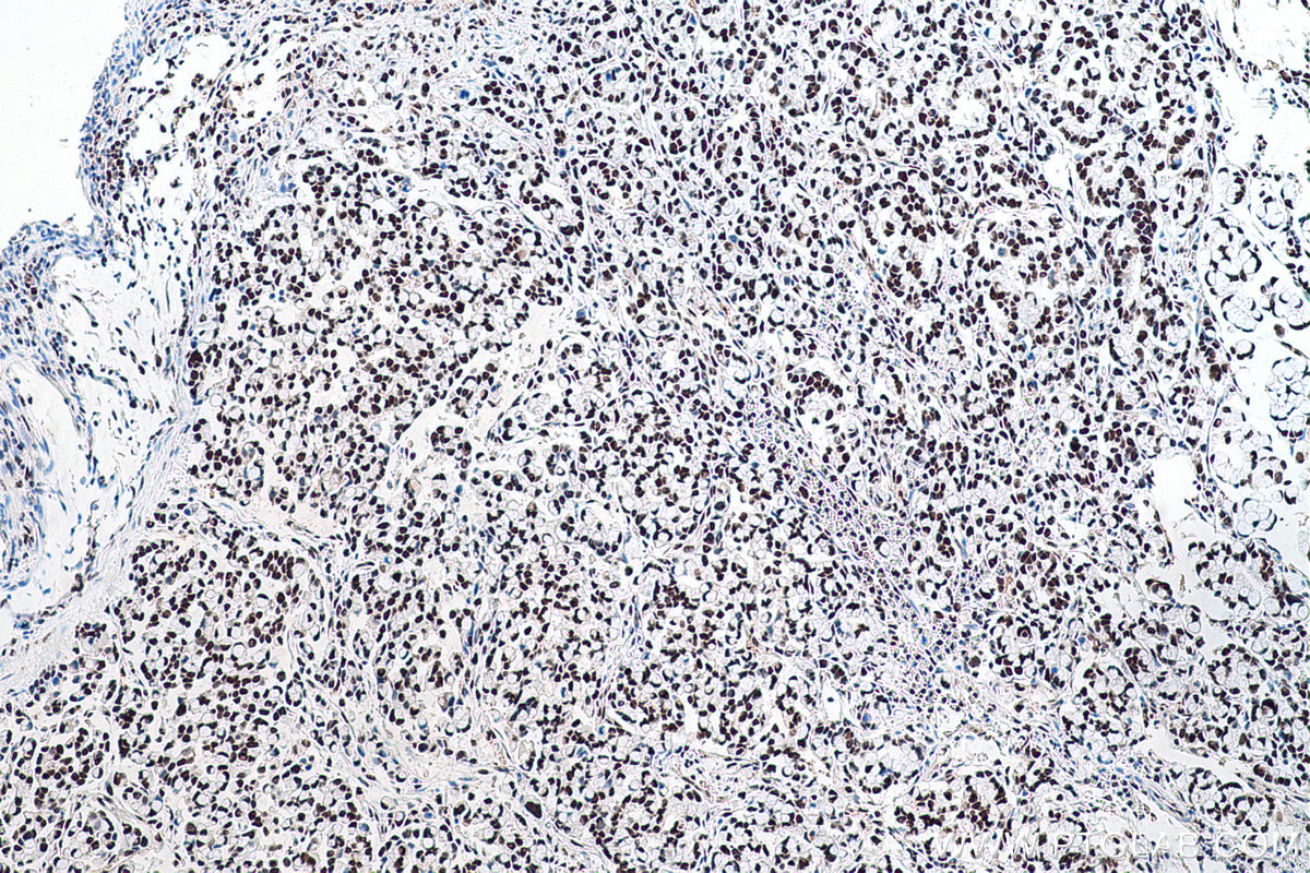 Immunohistochemistry (IHC) staining of human colon cancer tissue using Transketolase Monoclonal antibody (66016-1-Ig)