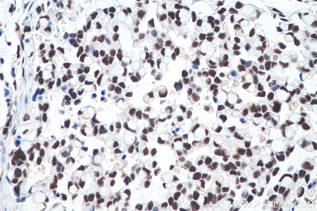 Immunohistochemistry (IHC) staining of human colon cancer tissue using Transketolase Monoclonal antibody (66016-1-Ig)